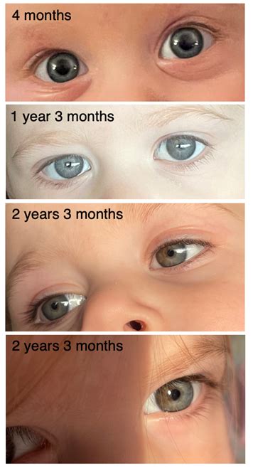 poe heterochromia|Talk:Heterochromia .
